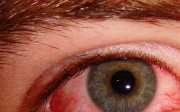 Červené oči nebo pupínky kolem očí